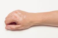 Vitiligo