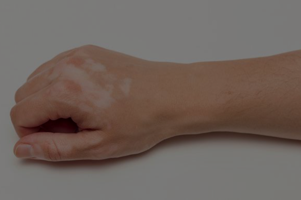 Camouflage / Vitiligo